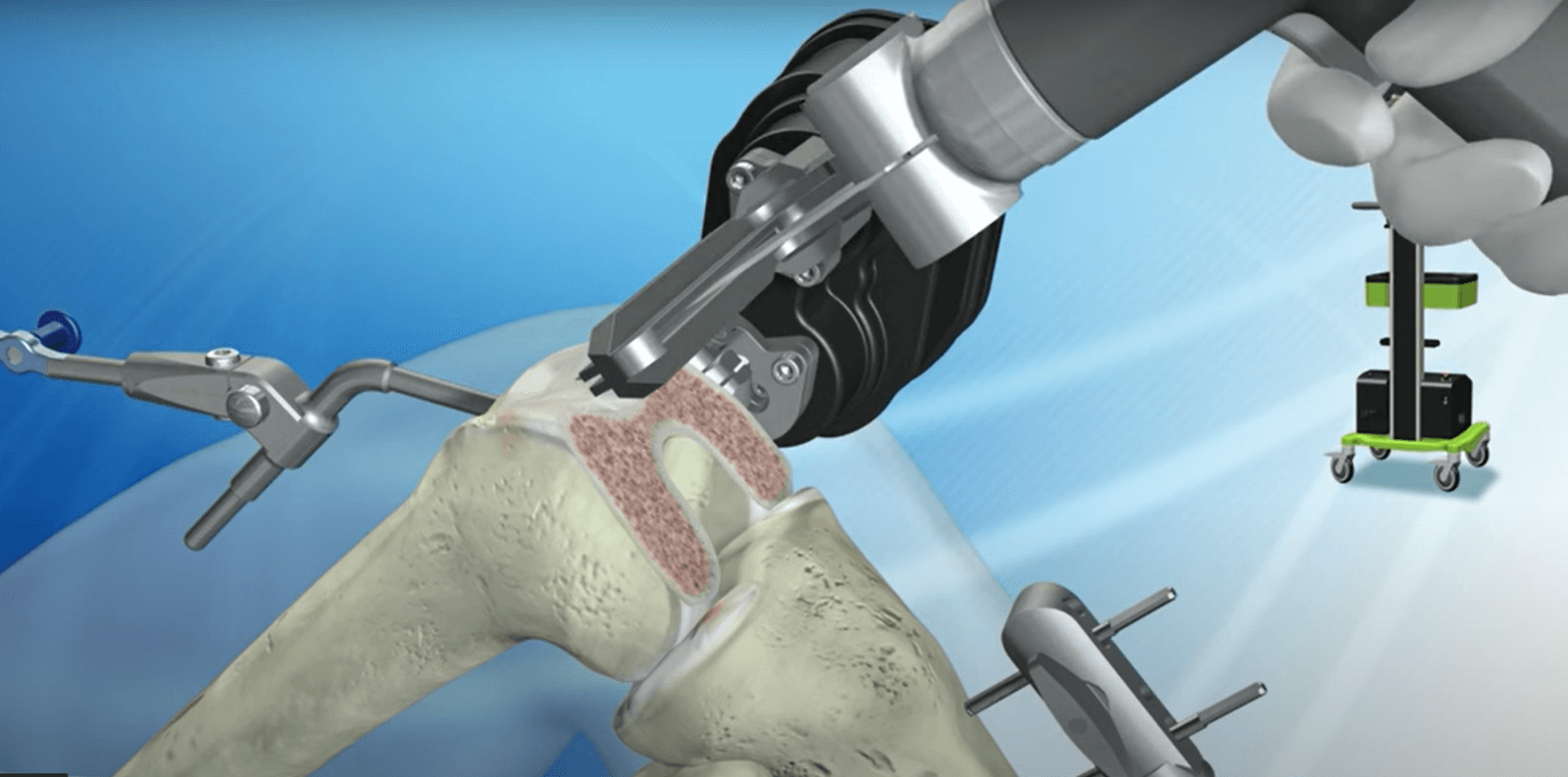 robot-asszisztált térdprotézis műtét